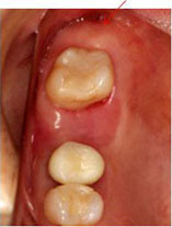 破折歯抜歯　２ヶ月後 （歯牙移植前）