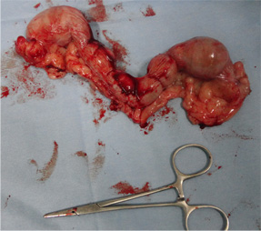 乳腺腫瘍と避妊の同時手術2