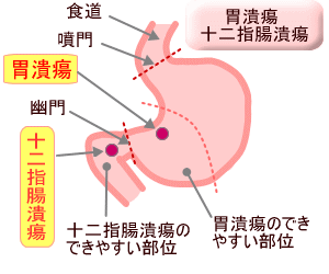 十二指腸潰瘍                nw('2013','12','20','07')